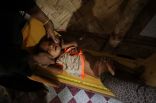 أطفال الروهنغيا يعانون سوء التغذية في بنغلادش