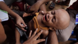  بكاء مؤثر لأطفال الروهنغيا المرضى في مخيمات اللجوء