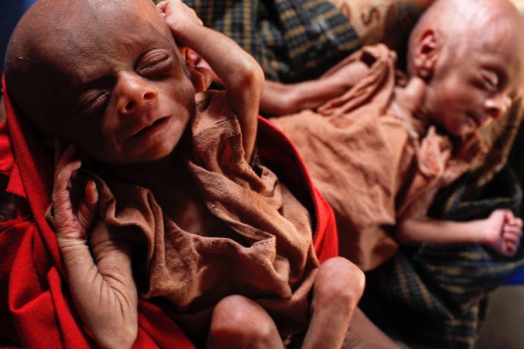 أطفال مسلمي الروهنجيا يتعرضون للموت البطيء